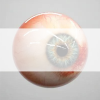 Hypertensive Retinopathy