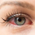 Dry Eyes Do’s & Don'ts (and the 3 Best Treatment Options) 5 dry eyes symptoms, dry eyes during pregnancy
