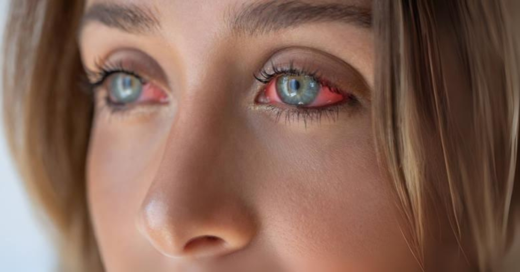Bloodshot Eyes