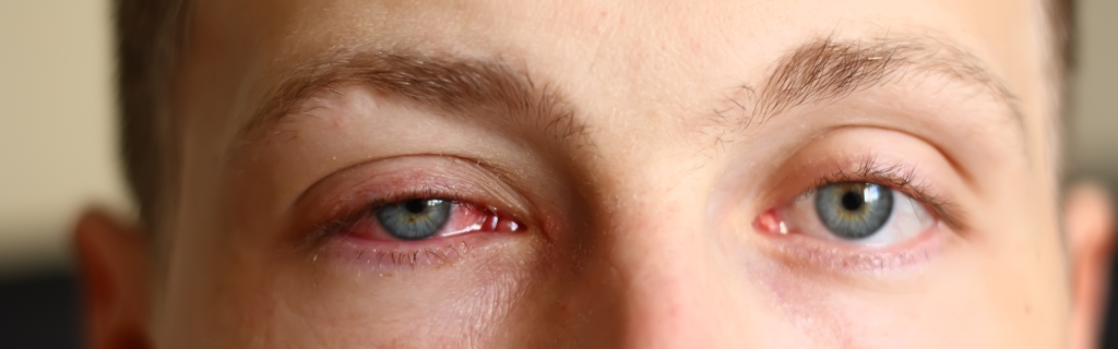 How to Get Rid of Pink Eye Fast