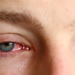 How to Get Rid of Pink Eye Fast: 4 Safe & Trusted Tips 11 How to Get Rid of Pink Eye Fast