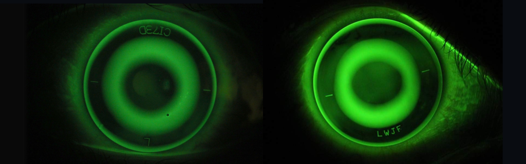Ortho K Lenses