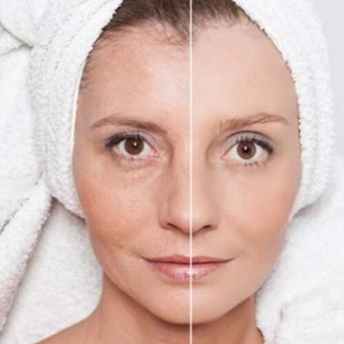 Radio Frequency Treatments